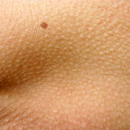 Die Haut bietet viel Fläche für etwaige Hautkrankheiten